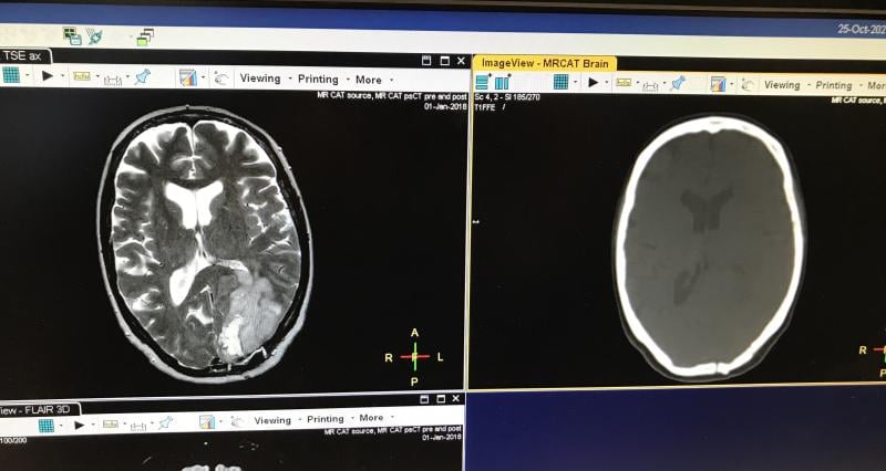 ASTRO 2021年展会上的一个大趋势是引入软件，现在可以将MRI数据集转换为合成CT图像数据集，用于治疗计划过程。这样就不需要CT扫描，可以加快护理速度，降低成本。飞利浦医疗保健公司在左边展示了原始的大脑MRI图像，在右边展示了合成的CT图像。