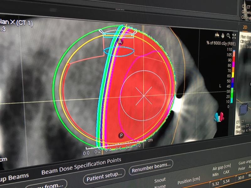射线搜索在2019年AAPM上展示的质子治疗眼部治疗计划。# AAPM2019 # AAPM