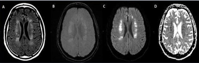 急性大脑前动脉/大脑中动脉分水岭梗死，47岁男性，表现为COVID-19肺炎。图片由RSNA提供