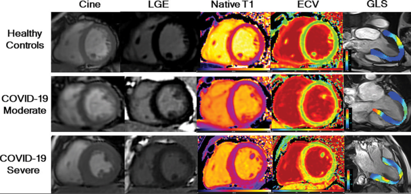 LGE图像、原生T1图、细胞外体积图和全局纵向应变(GLS)显示中、重度COVID-19恢复期成人心肌异常。注意:此图片仅用于说明目的，与十大研究组无关。图片由放射学提供。