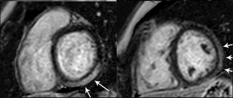 MRI显示青春期女性左心室基底下段和下段及中心室水平左心室前段、下段和下段的明显LGE累及50%以上的心肌。注意:此图片仅用于说明目的，与十大研究组无关。影像由放射科提供:心胸影像学。