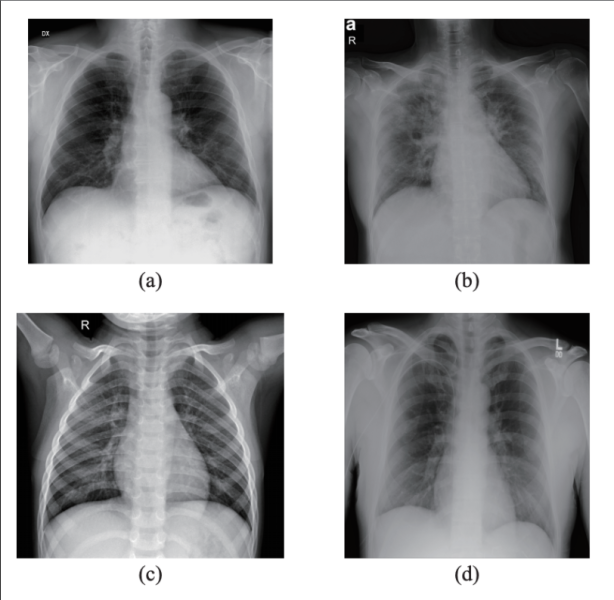 来自本研究中使用的数据集的样本。(a)一名COVID-19患者的x光片和PA视图;(b)一位COVID-19患者的x光片和AP片;(c)数据集a中一名健康患者的x光片;(d)数据集b中健康患者的x光片。图片由IEEE/CAA自动化学报提供