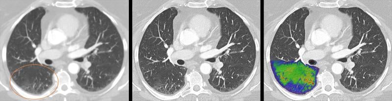 新冠肺炎后患者使用西门子Naeotom Alpha光子计数CT系统的肺部图像。光子计数技术可以同时获取和可视化细节结构(中心图像)结合功能信息(右图像)。左图为常规CT图像对比图。捷克共和国Plzen大学医院J. Ferda医生提供。<a href=