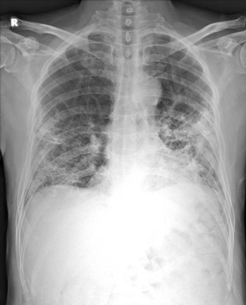 肺部数字x线片显示肺下叶COVID-19肺炎。图片来自Thirona和Delft Imaging。