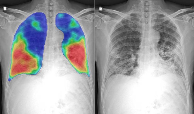 许多供应商已经开发了人工智能(AI)算法，通过CT或DR成像自动检测和评分肺部COVID-19肺炎的严重程度。胸片显示的是由Thirona和Delft Imaging公司开发的CAD4COVID AI软件。它将生成一个0到100分之间的分数，表明与COVID-19相关的异常程度，通过热图显示这种肺部异常，并量化肺部受影响的百分比。肺部的冠状病毒区表现为