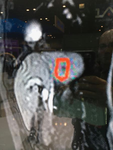 这是在ASTRO 2019上用Elekta Unity MRI引导的RT系统演示的肝脏肿瘤放射治疗束传输的实时MRI成像示例。它展示了实时成像如何显示呼吸引起的器官/肿瘤运动。目前，如果肿瘤移动超出耐受范围，放射治疗师可以关闭光束，但该公司正致力于自动关闭/打开光束功能，以考虑运动。# astro19 # astro2019 # astro