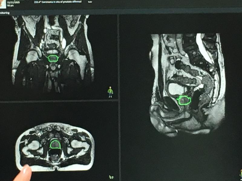 这是在ASTRO 2019上用Elekta Unity MRI引导的RT系统演示的肝脏肿瘤放射治疗束传输的实时MRI成像示例。它展示了实时成像如何显示呼吸引起的器官/肿瘤运动。目前，如果肿瘤移动超出耐受范围，放射治疗师可以关闭光束，但该公司正致力于自动关闭/打开光束功能，以考虑运动。