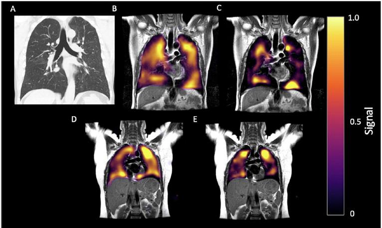 60岁男子长时间感染covid。covid后呼吸困难史，显示出院后172天。(A) CT， (B)氙129 MRI通气显像，(C) RBC相位显像。(D)健康对照的Xe-129 MRI气体成像和(E) RBC相位成像。x -129 MRI图像显示冠状位，由于微栓子，患者红细胞被破坏。图片由RSNA提供。