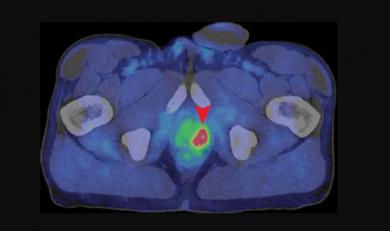 轴向融合PET/CT图像显示，62岁的放疗前列腺癌患者，骨盆深部伴前列腺左叶摄取强烈(箭头)。CT扫描没有发现肿瘤。图片由北美放射学会提供。