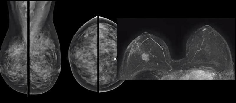 一名乳房致密的女性的标准乳房x光造影成像(左)和一项乳房MRI成像研究(右)的对比显示，一种明确的癌症，在乳房x光检查中很难发现。