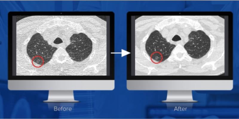 麻省总医院和弗吉尼亚大学进行的研究得出结论，PixelShine，一项来自algomeedica的颠覆性技术，显著提高了在减少辐射剂量下获得的CT扫描的诊断质量。在这里，你可以看到降噪前后的情况。