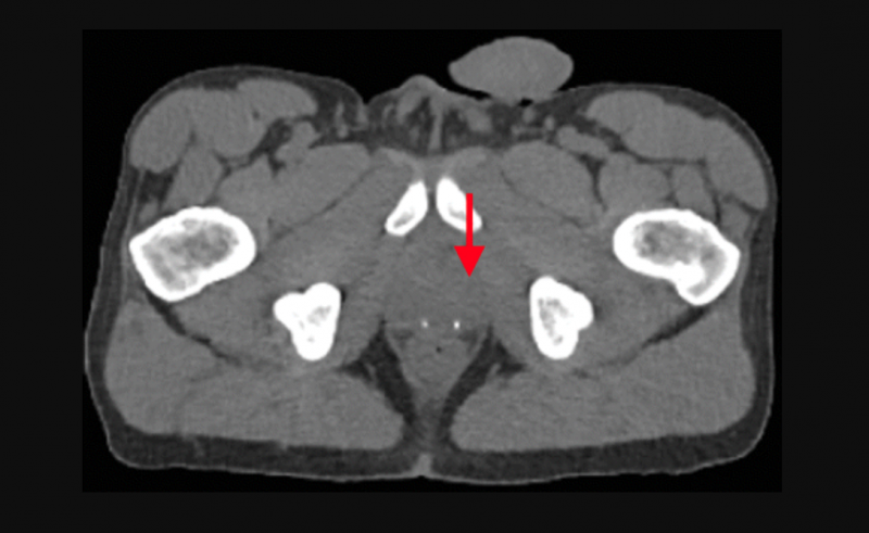 轴向融合PET/CT图像显示，62岁患者有前列腺癌放疗史，对应前列腺左叶的盆骨深部摄取强烈(箭头)。CT扫描没有显示肿瘤。图片由北美放射学会提供。