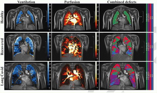 0.55T自由呼吸相分辨功能肺(PREFUL)低场MRI，自动配准到呼气中位置并分割肺实质后，轴向面计算参数。从左到右，具有代表性的功能彩色编码图像显示了健康对照组(上排，7岁男性)的通气缺陷(VDP，蓝色)、灌注缺陷(QDP，红色)、通气/灌注缺陷(V/Q匹配，绿色)、通气/灌注缺陷(V/Q缺陷，紫色)、参与者rec