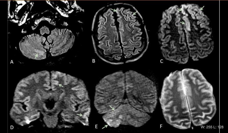 图2摘自《放射学:急性脑病》。60岁男性，无癫痫发作史，以抽搐表现。(A-B)右侧小脑(A箭头)、左侧前扣带皮层和额上回(B箭头)多灶FLAIR高强度区。(C-D)左侧前扣带皮层、额上回和颞中回(D箭头)和右侧小脑(E箭头)弥散受限，与小脑舒张一致。F) # COVID19