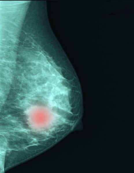 人工智能有潜力帮助放射科医生提高乳腺癌成像的效率和效果