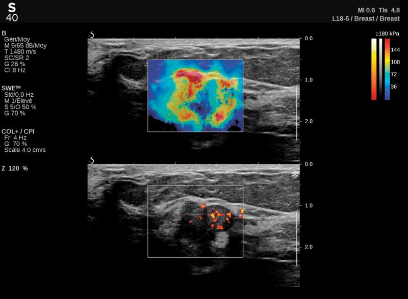 这是一个乳房三维超声成像的例子，旨在帮助提高效率和诊断准确性在任何实践。图片由Hologic提供。