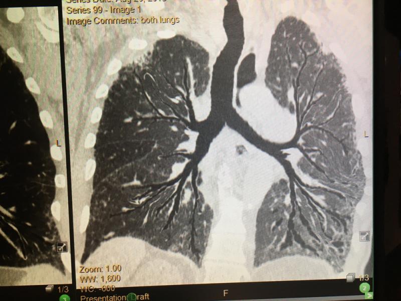 这是一种人工智能(AI)的肺支气管重建图像的一张图像，由供应商Vida在其LungPrint软件中演示。而不需要跟踪CT研究的每个分支。目的是提供气道的快速视图，帮助快速识别任何问题。当AI在扫描中识别任何东西时，如疑似结节、慢性阻塞性肺病或肺气肿，Hyperion视图也用作参考图像。