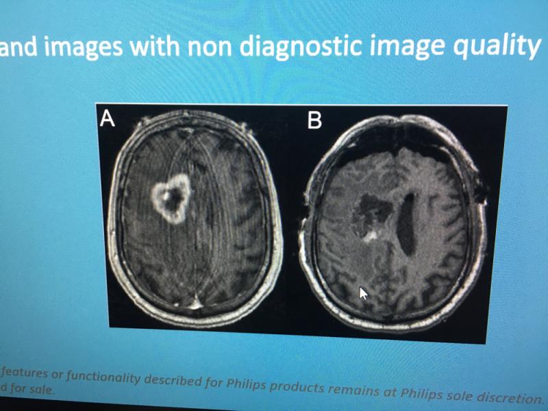 飞利浦医疗保健公司正在使用人工智能(AI)更好地重建MRI图像，以去除伪影并提高图像质量。这个AI如何去除MRI伪影的例子是由供应商在2019年RSNA的展台参观期间展示的，