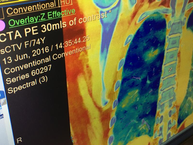 一个例子的频谱CT显示位置肺栓塞(PE)使用碘图覆盖在CT解剖成像。特写显示了双能量图像上的两个PEs，以及碘图是如何在内部和外部水平定位低灌注或无灌注的区域。你可以看到罪魁祸首血管部分的凝块。这在2019年RSNA上的飞利浦展台上展示了来自IQon扫描仪的图像。