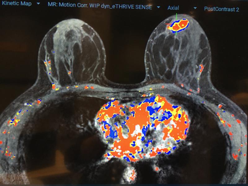 Qlarity Imaging公司的QuantX人工智能(AI)软件用于辅助放射科医生，通过磁共振造影自动评估和描述乳腺病变。该系统已获得FDA批准。# RSNA # RSNA2019