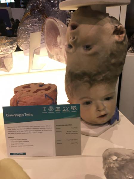 这是一个头部连体双胞胎的病例，他们在CT扫描的3D打印帮助下计划了复杂的手术。他们的大脑之间有共同的血液供应，这是他们的头部和大脑的术前打印扫描图。这需要几次外科手术来分离血管，3d打印的大脑扫描图上用绿色标记标出了这些血管。该案例由供应商3D Systems在2019年RSNA上展出。