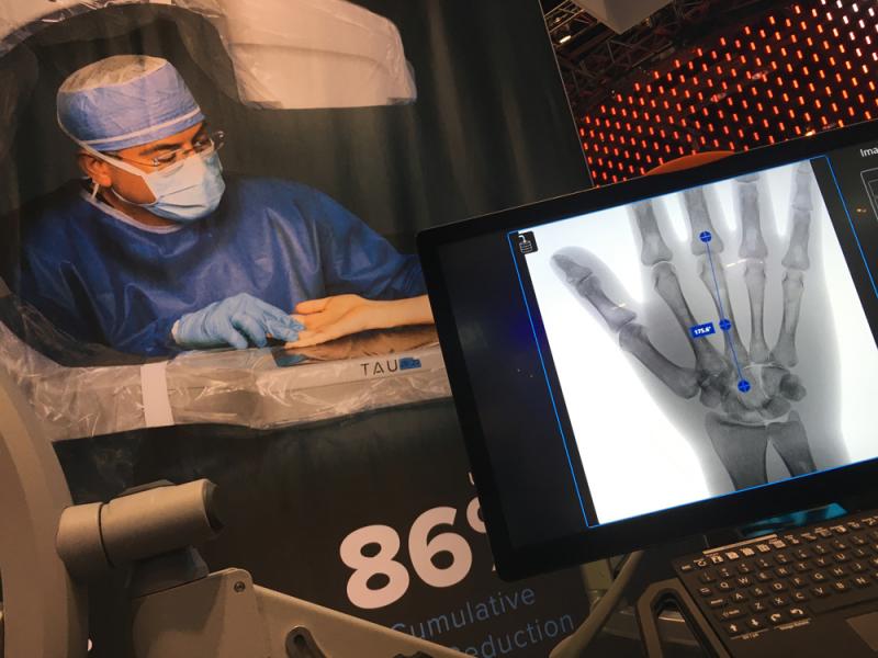 Orthoscan于2019年推出了新的Tau 20/20迷你c臂系统，该供应商表示，这是迷你c臂系统可用的最低剂量。它有FDA的儿科适应症，有一个20 x 20英寸的探测器。