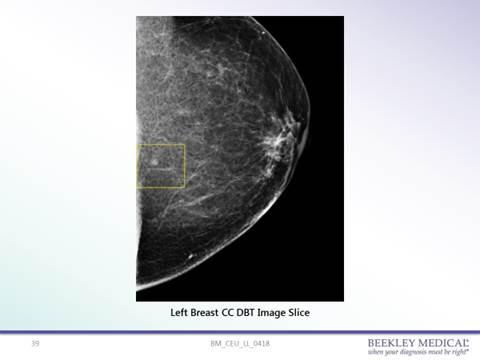 62岁女性，接受3D乳房x光检查。一个不确定的低密度边界肿块的位置没有明确地确定为皮肤线或仅仅在表面以下。