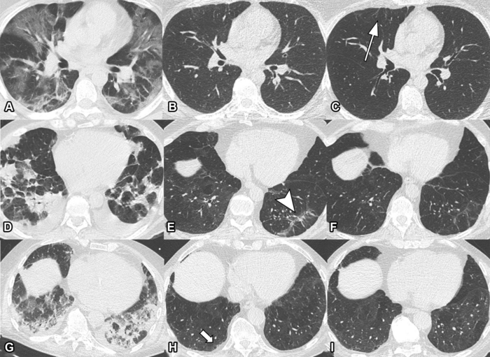 对三名既往患有COVID-19肺炎的研究参与者进行系列非对比轴向胸部ct检查。