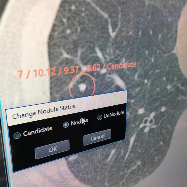 日立开发的人工智能(AI)的一个例子，用于自动检查和识别肺部CT扫描上的结节。这是日立正在开发的一套人工智能应用程序的一部分。这个例子在RSNA 2019上作为一项正在进行的工作展示。