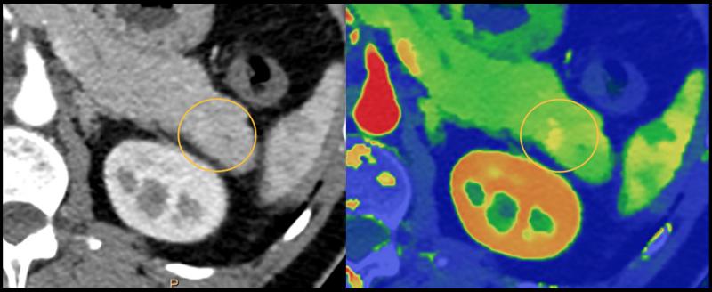 一个例子，频谱CT如何帮助胰腺CT诊断可能有一个小的病变，但很难看到。双能显像清晰显示病变。这个例子来自飞利浦光谱CT 7500系统。