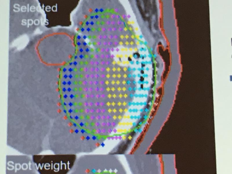 脑瘤的铅笔束质子治疗方案的一个例子。每个点都是肿瘤中质子能量沉积的位置。颜色代表给药剂量。# ASTRO2018 # ASTRO # ASTRO18