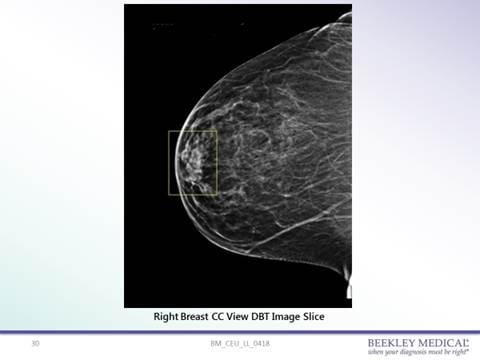 42岁女性患者，每年例行3D乳腺造影。右乳晕显示乳晕后区域乳腺前部不透明。