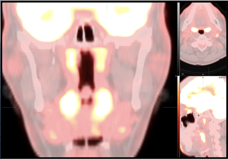 工作组成员最近在FDG PET/CT或FDG PET/MR上观察到一种不同寻常的成像模式，可能是由于COVID-19感染所致。