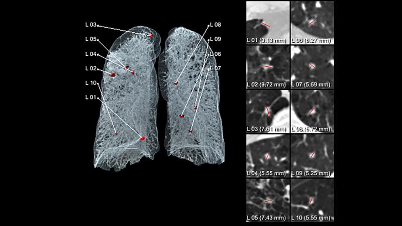 西门子AI-Rad伴侣胸部CT提供自动可视化胸部图像，以支持其阅读和报告。