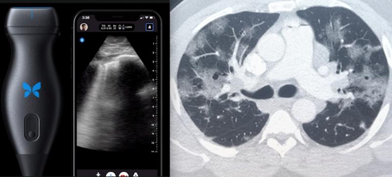 今年ITN上排名前两位的视频都涉及使用点监护超声(POCUS)对COVID进行医学成像，以及大规模移动到远程放射学，使放射科医生能够远程工作，并与转诊医生进行虚拟合作。左边的图片是将智能手机变成超声波机的蝴蝶公司的POCUS系统，图片是肺中的COVID b线。右边的图片是新冠肺炎的CT扫描。# COVID19
