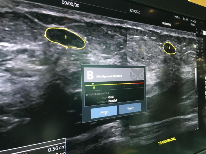 Logiq E10系统上正在开发的用于评估乳腺超声病变的人工智能应用程序。