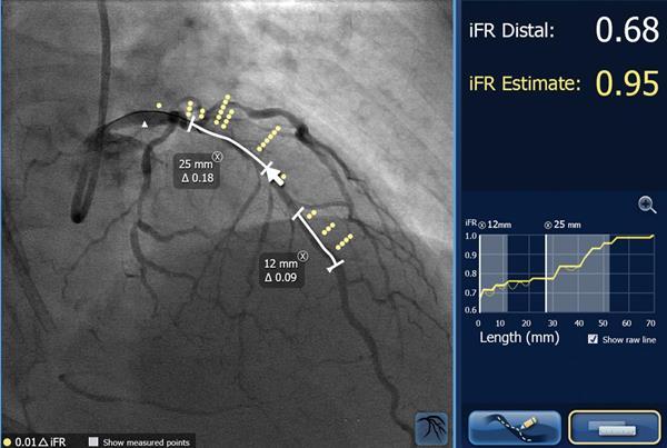 来自飞利浦医疗保健的SyncVision iFR联合注册将iFR压力读数映射到血管造影。