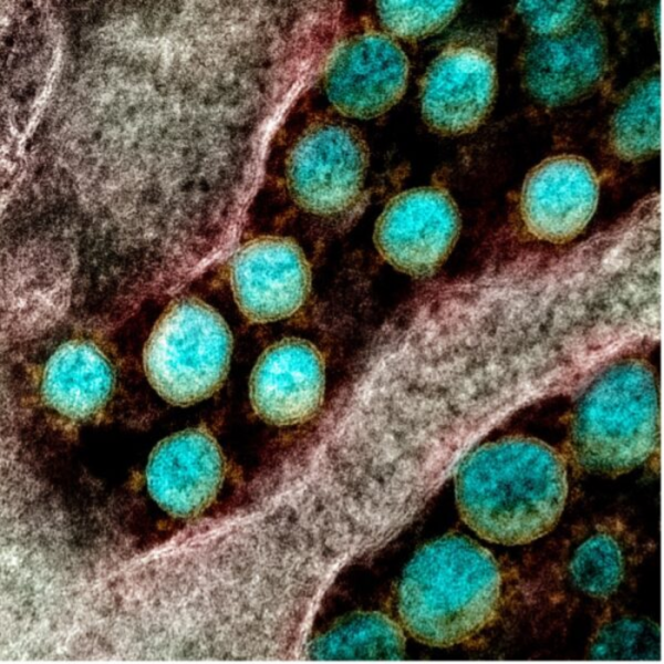从病人身上分离的SARS-CoV-2病毒颗粒的透射电镜照片。位于马里兰州德特里克堡的NIAID综合研究设施(IRF)捕获并增强了颜色。图片由NIAID提供