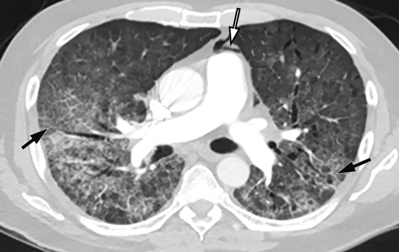 一名61岁男子并发COVID-19纵隔气肿。轴向胸部CT血管造影图像显示典型的COVID-19肺炎表现，包括弥漫性GGOs和小叶间隔增厚(黑色箭头)。空气位于肺动脉前方(白色箭头)，与肺动脉主动脉和左心耳相邻，提示纵隔气肿。图片由Margarita Revzin等人提供。COVID在肺