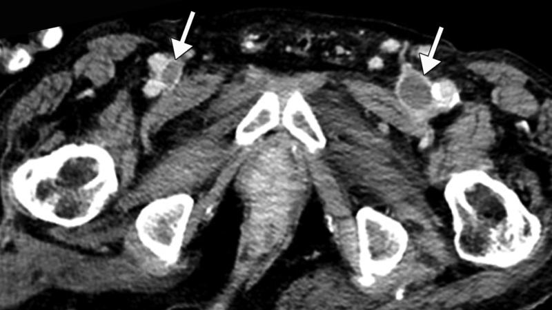 1例78岁男性COVID-19患者发生下腔静脉(IVC)和周围深静脉血栓形成(DVT)，伴下肢肿胀和腹痛。轴向增强CT图像显示双侧股总静脉充盈缺损(白色箭头)。图片由Margarita Revzin等人提供。
