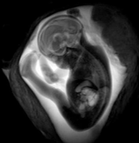 两位具有多年胎儿MRI经验的认证放射科医生对MRI扫描进行了评估。他们发现，所有胎儿在评估区域的大脑发育都与年龄相符。没有发现胎儿大脑感染的迹象。