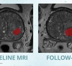 RSIP Vision是一家通过先进的人工智能(AI)和计算机视觉解决方案推动医学成像创新的经验丰富的领导者，宣布了一种用于前列腺MRI分析的新工具。