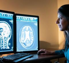 WVU医学院和洛克菲勒神经科学研究所的研究人员Rashi Mehta的一项新研究发现，聚焦超声可能在阿尔茨海默氏症患者的大脑中诱导免疫愈合效应。