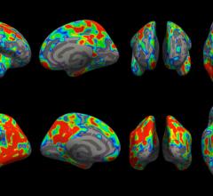 大脑中有颜色的区域代表了早期阿尔茨海默症患者大脑突触的损失比认知功能正常的人更大的区域。