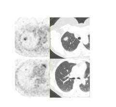 肺RUL腺癌F-18 FDG PET/CT图像显示Vereos的价值。右上肺叶原发病变(左侧PET图，右侧CT图)。下行可见RUL中3mm的同步原发或转移病灶。Vereos图像提供的精确性为患者接受RUL肺叶切除术而不是对原发病灶进行热消融提供了依据。Images courtesy of Dr. Jay Kikut and UVM