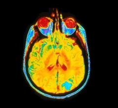 用磁共振成像仪(MRI)拍摄的人脑单张图像。图片由Leon Kaufman博士提供。加州大学旧金山分校
