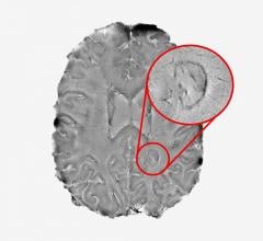 阴燃斑点在大脑中可能意味着严重的女士