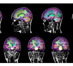 Neuroreader Report通过分析MRI序列来判断大脑结构是否异常以及异常程度。它能在核磁共振成像后不到十分钟的时间内可视化和量化45个大脑结构