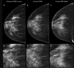 莫菲特人员开发模型个性化乳腺癌放射治疗
