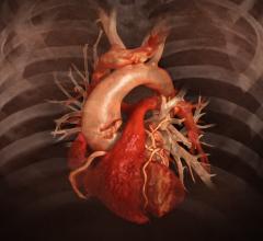 新型Aquilion One Genesis SP心脏CT系统使用人工智能帮助重建低剂量心脏CT图像。# SCCT2020